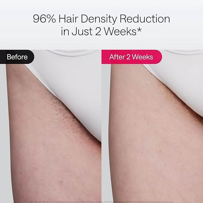 Ulike Air 10 IPL hair removal device shown in a modern, minimalist setup—perfect for painless hair reduction at home with ice-cooling and skin sensor safety.